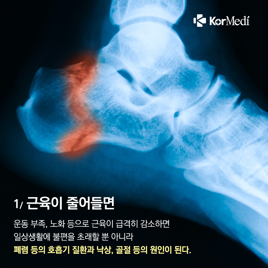 0402_코메디닷컴_30대부터_줄어든_근육_왜_중요할까_03