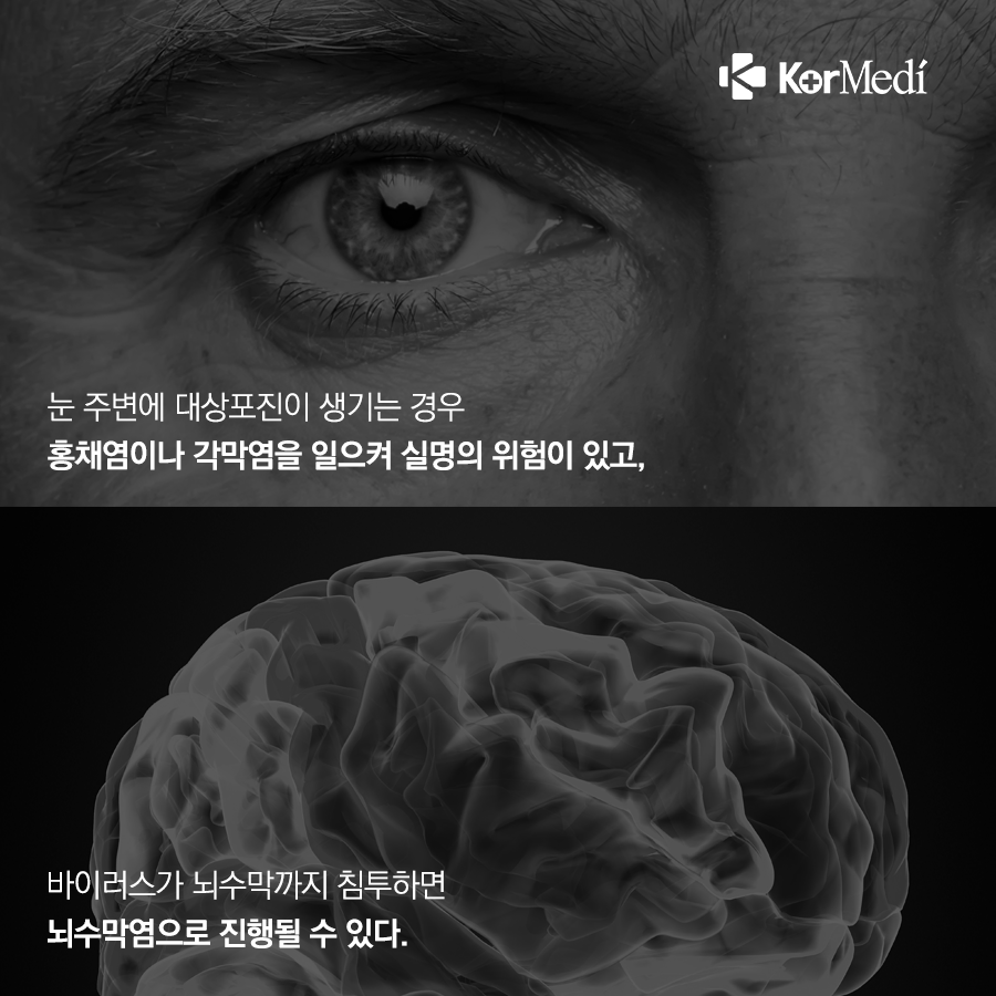 0410_코메디닷컴_찬바람_불_땐_대상포진_조심하세요_06