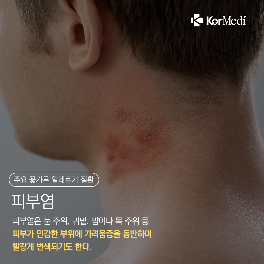 0415_코메디닷컴_꽃가루_농도_위험지수를_아시나요_06