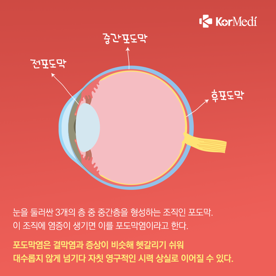 0423_코메디닷컴_결막염인_줄…실명_가능한_‘포도막염’_02