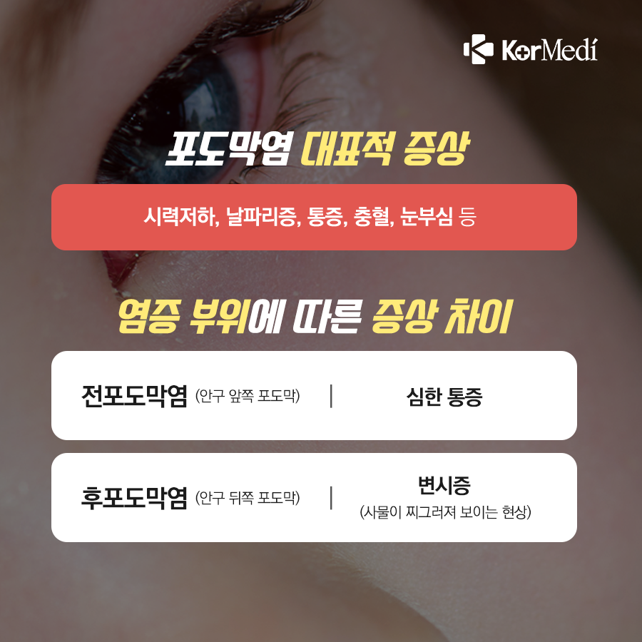 0423_코메디닷컴_결막염인_줄…실명_가능한_‘포도막염’_04