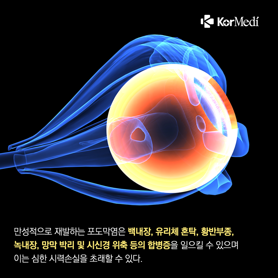 0423_코메디닷컴_결막염인_줄…실명_가능한_‘포도막염’_05