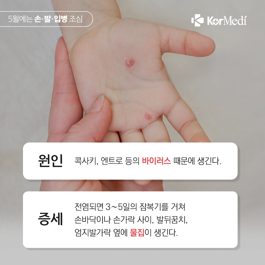 0502_코메디닷컴_5월엔_아이들_손·발·입병_조심_03