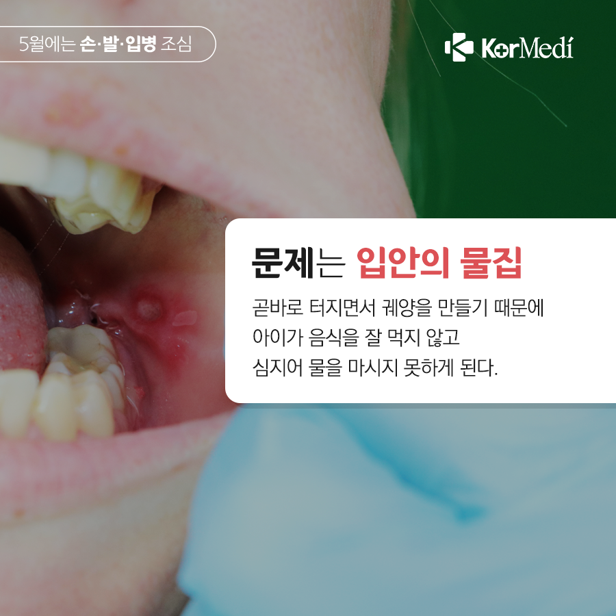 0502_코메디닷컴_5월엔_아이들_손·발·입병_조심_04