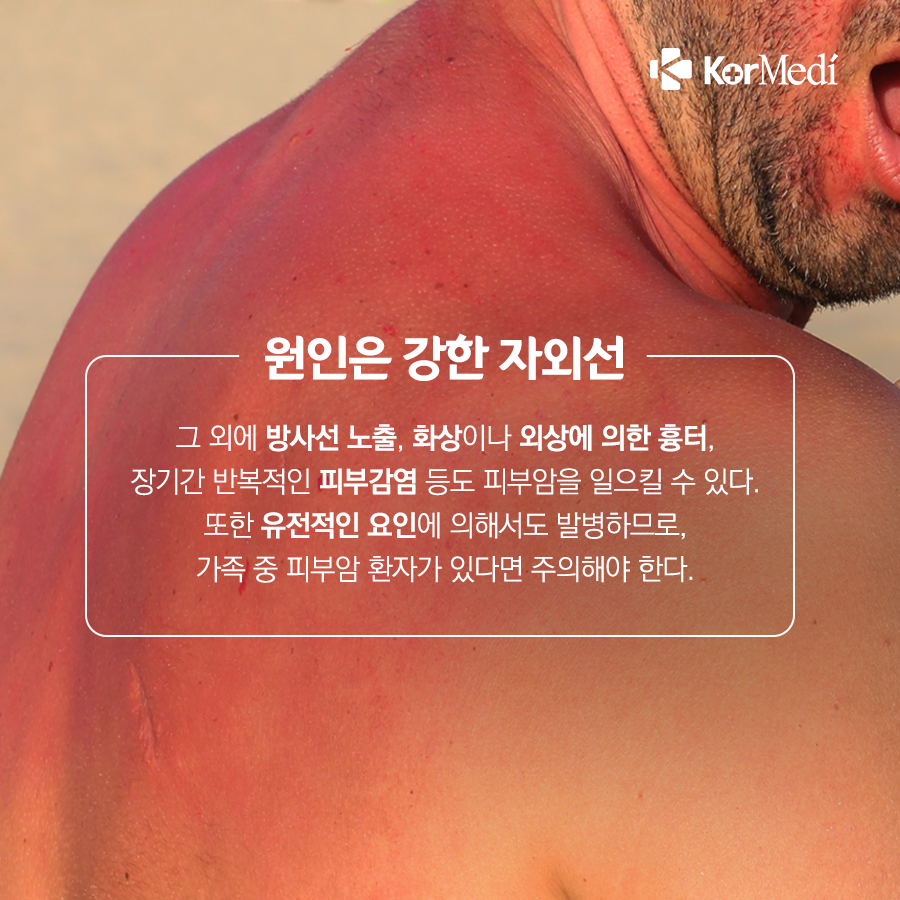 0516_코메디닷컴_점인가_했는데_피부암_03