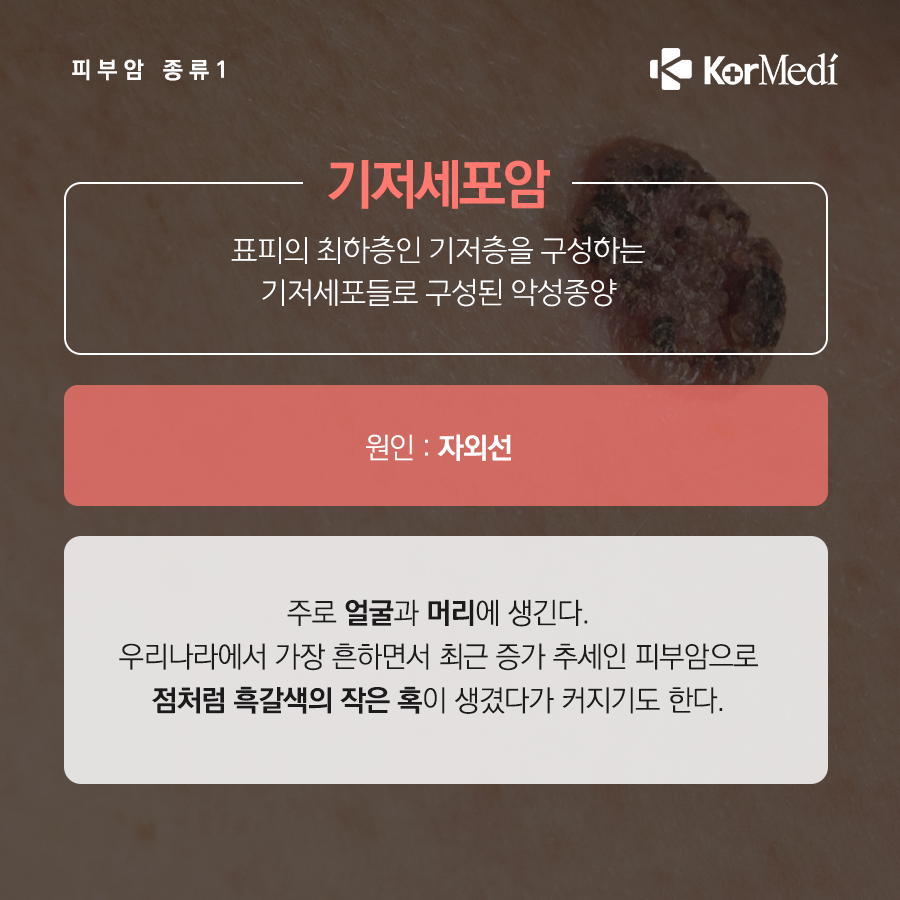 0516_코메디닷컴_점인가_했는데_피부암_05