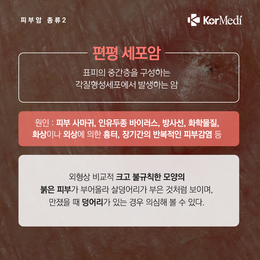 0516_코메디닷컴_점인가_했는데_피부암_06