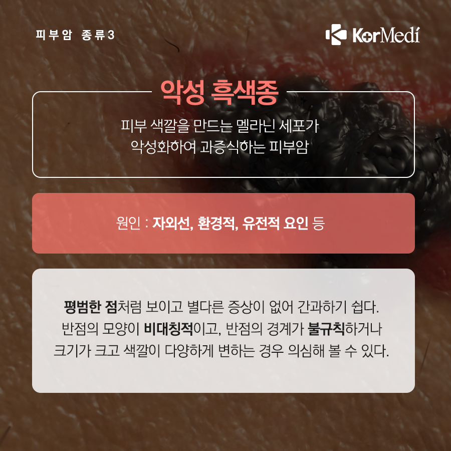 0516_코메디닷컴_점인가_했는데_피부암_07