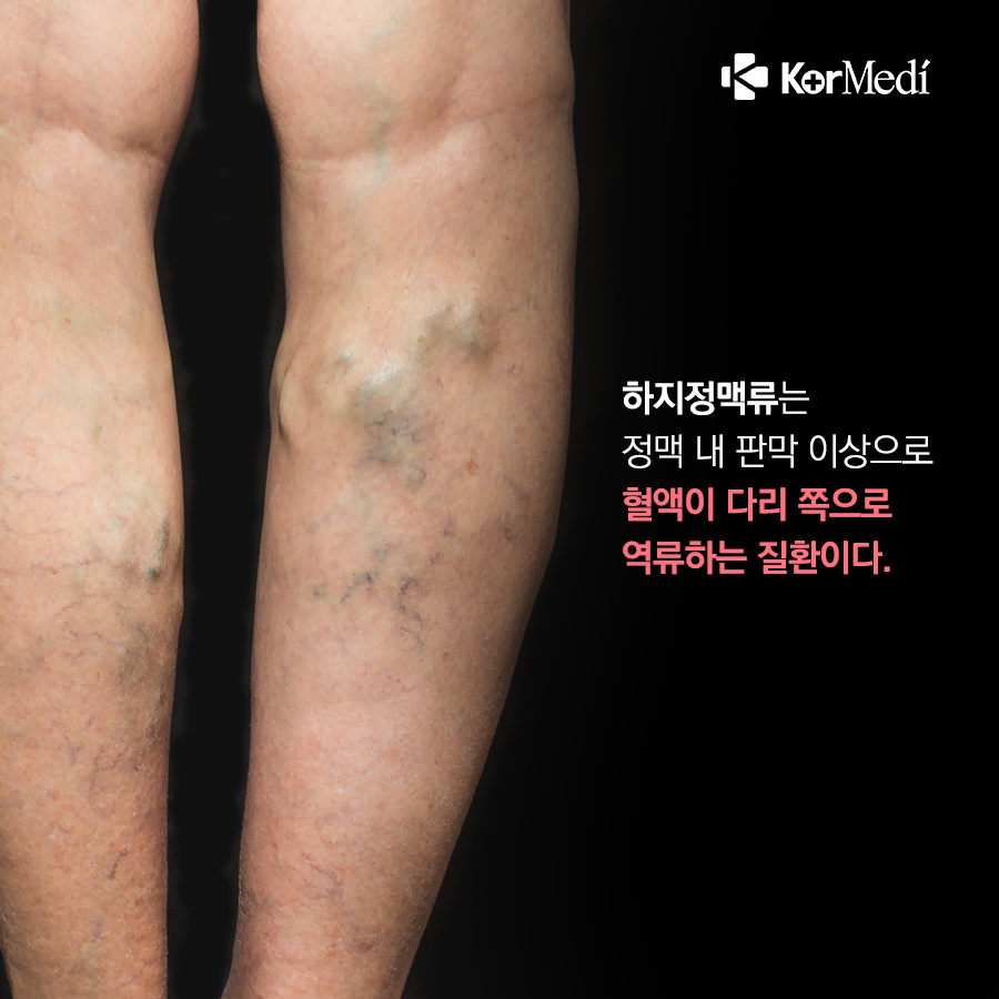 0524_코메디닷컴_하지정맥류_02