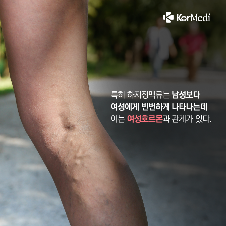 0524_코메디닷컴_하지정맥류_04