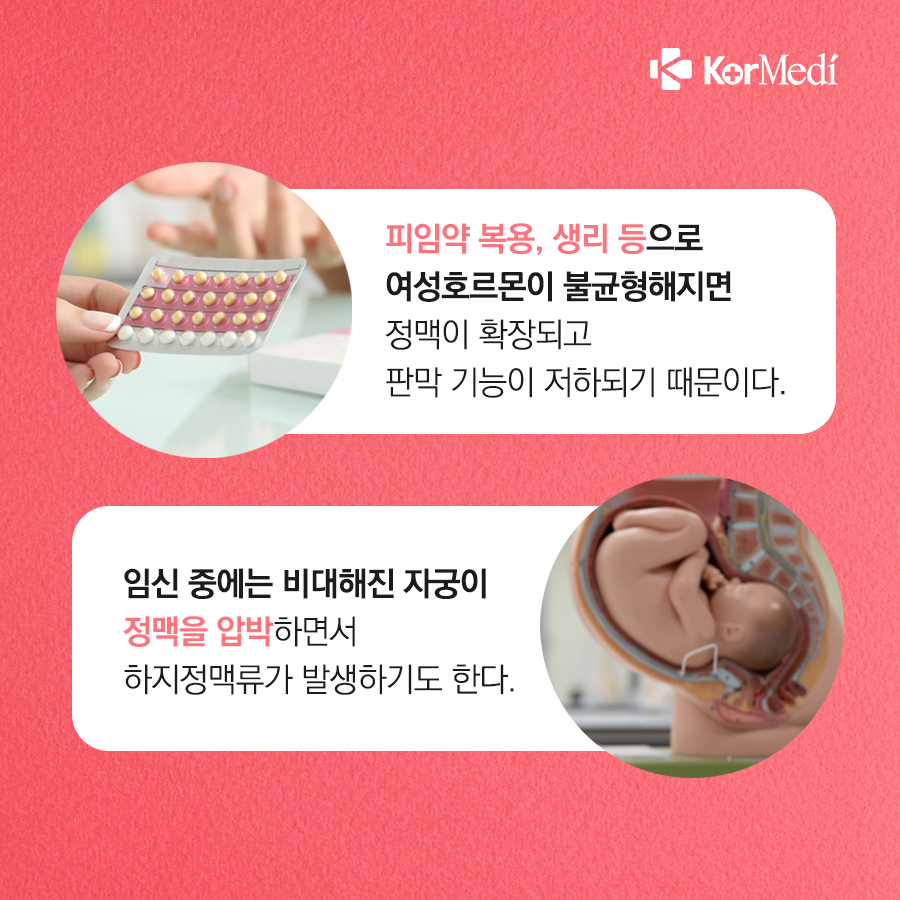 0524_코메디닷컴_하지정맥류_05