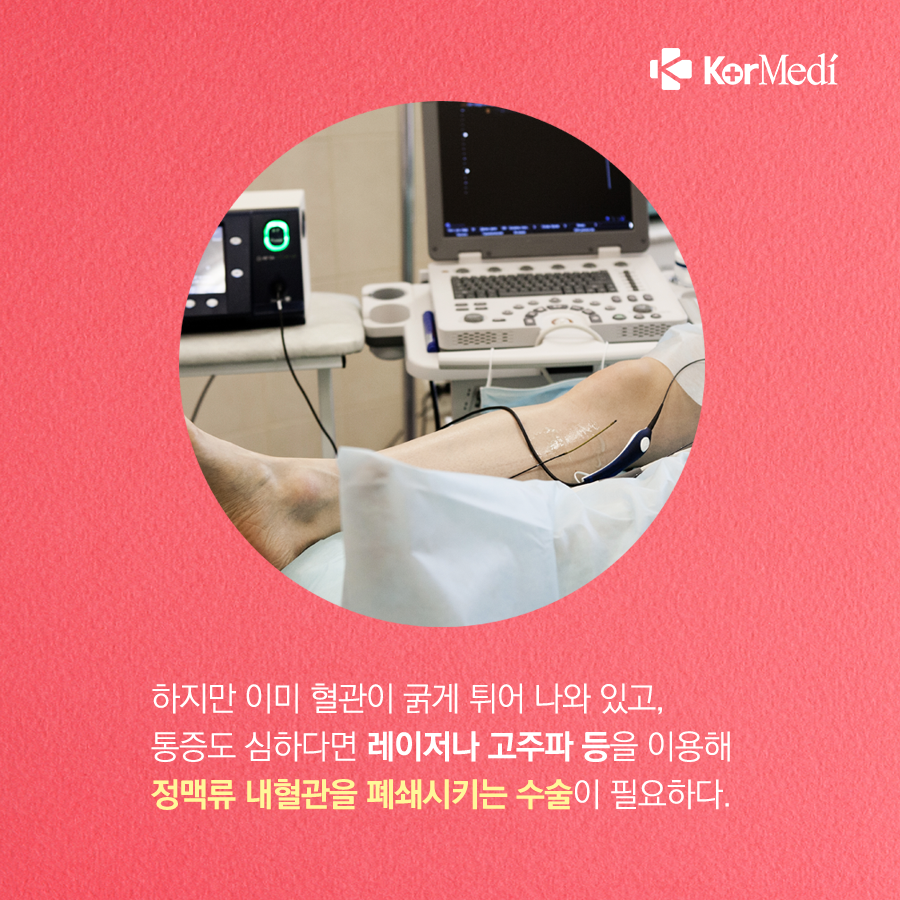 0524_코메디닷컴_하지정맥류_07