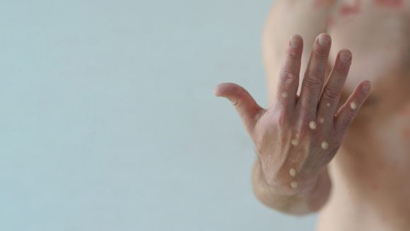 손에 발생한 수포성 발진