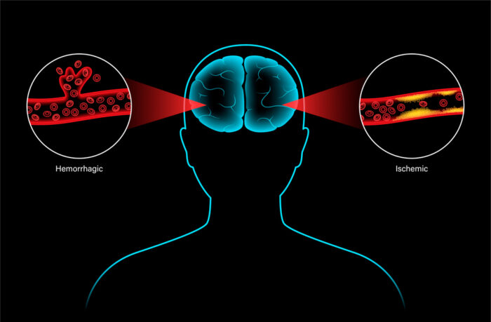 뇌경색과 뇌출혈의 뇌 혈관 이미지