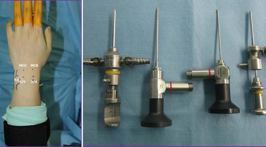 "Ultimate Guide to Treating Chronic Wrist Pain Diagnosis, Treatment, and Prevention" Archyde