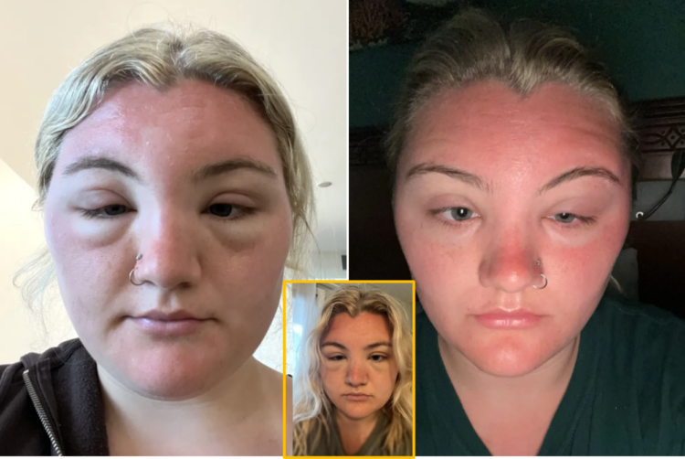 Sun-Swollen Eyes: My Face Looks Like ET! Sun-Swollen Eyes: My Face Looks Like ET!