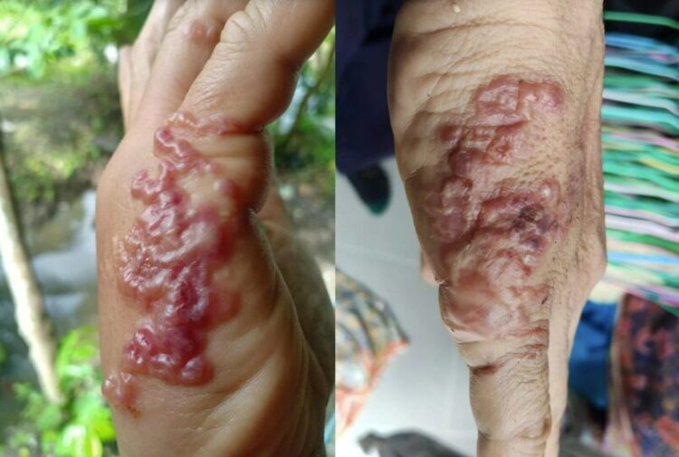 Weed Pulling & Skin Parasites: A Gardener’s Warning Weed Pulling & Skin Parasites: A Gardener’s Warning