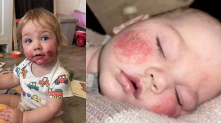 Baby with atopic dermatitis