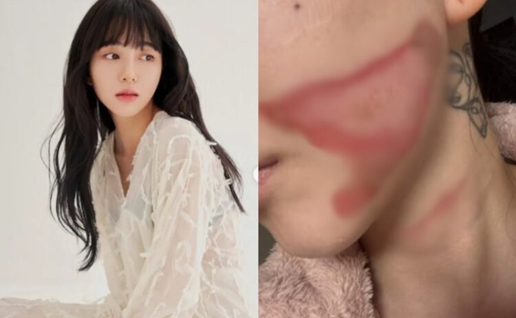 AOA Kwon Min-ah, Horrific 2nd Degree Burns After Skin Treatment... What Happened?
