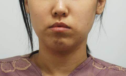 Why Reducing Your Face Can Make It Look Longer: The Hidden Risks of Midface Surgery