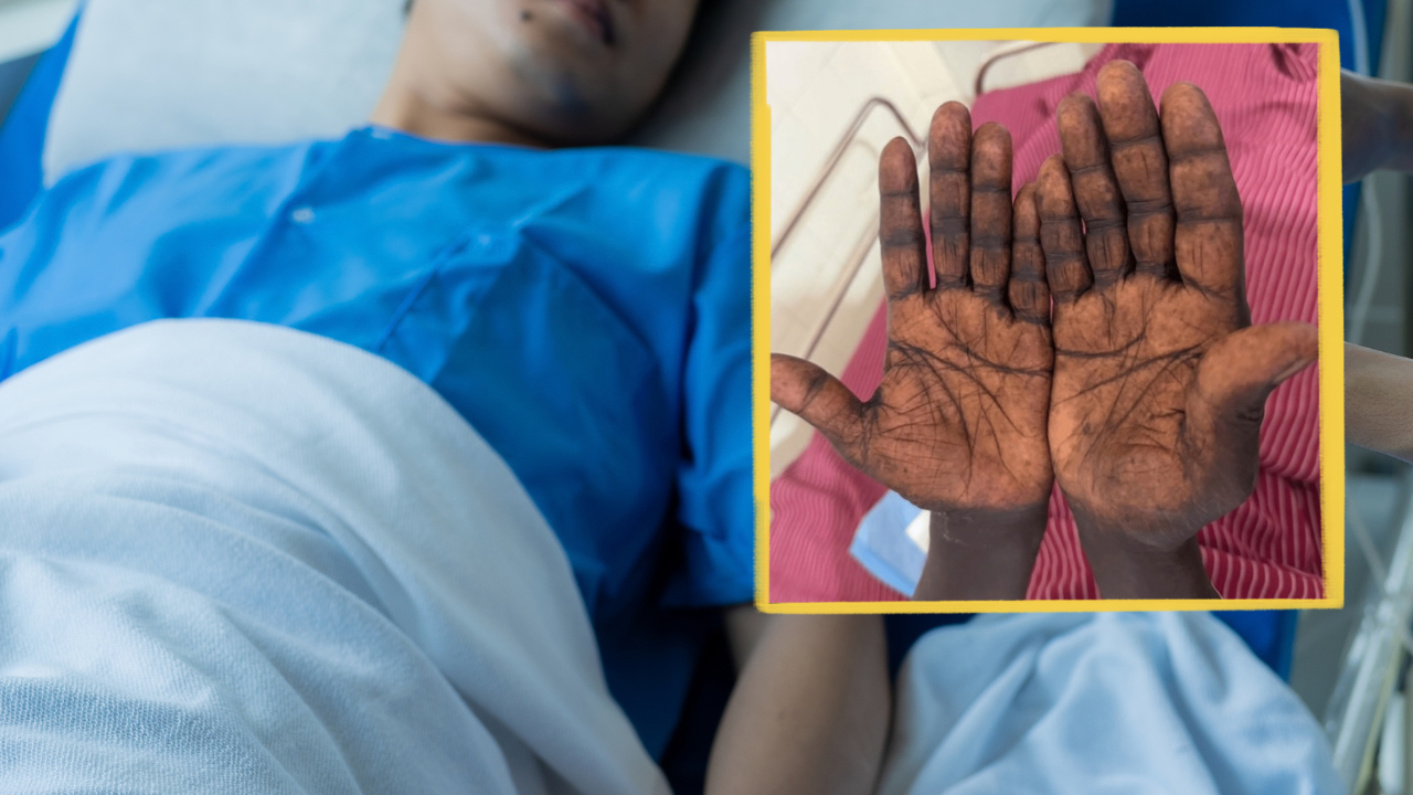 “손금까지 까맣게 변해”…67세男, 온몸 검게 만든 ‘뜻밖의 원인’